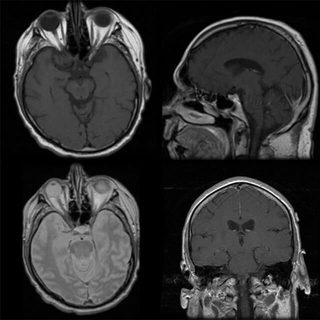 MRIでとらえた頭部画像